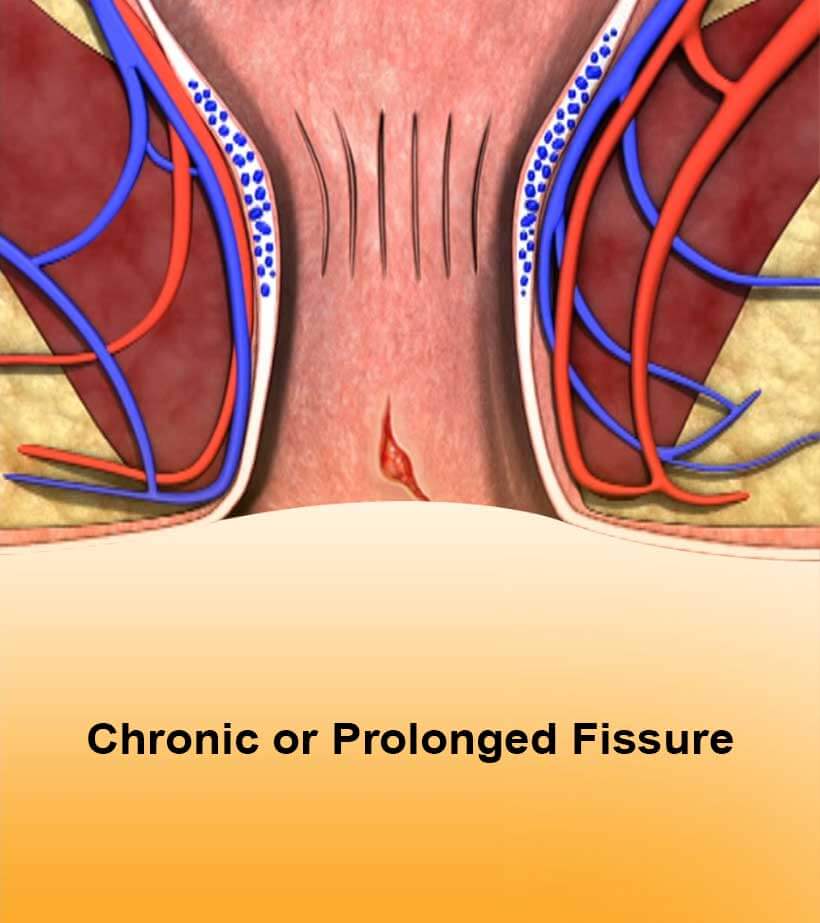 Chronic Fissure